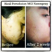 Mengatasi masalah wajah, hanya dengan NANO SPRAY!-image-5.jpg