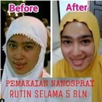 Mengatasi masalah wajah, hanya dengan NANO SPRAY!-image-6.jpg