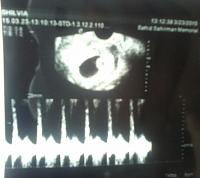 kehamilan 7w sudah terdengar detak jantung-detak-jantung.jpg