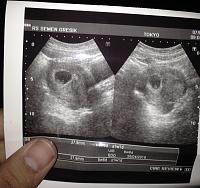 Pendarahan di usia kehamilan 7 week-image.jpg