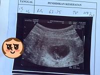 My second pregnancy (7 weeks)-12734269_10205812297377974_6914048882212592684_n.jpg