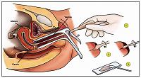 Penjelasan Soal Pap Smear, Gratis atau Berbayar...?-papsmear.jpg