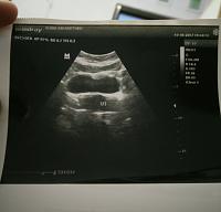 Jika tidak ada kehamilan kenapa rahim saya terlihat bulat di USG-img_20170820_073842.jpg