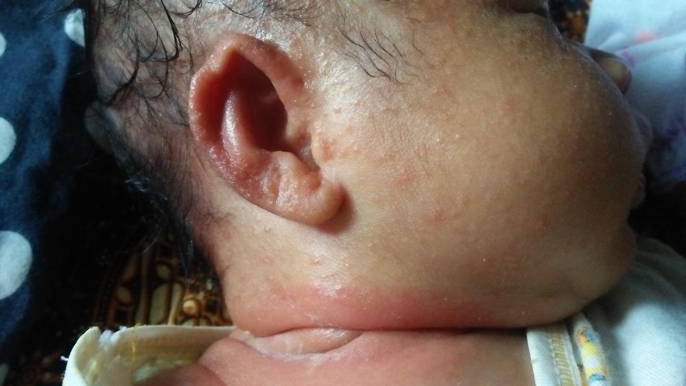 46++ Kenapa bayi naik ruam di muka ideas