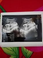 Normalkah ukuran janin dg usia 14 minggu-img-20171106-wa0011.jpg