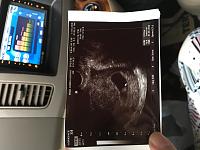Kehamilan ke-4,, Riw abortus dan BO-7e289b25-a752-45cc-9ad7-dd8e39e96ecf.jpg