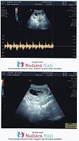 Hasil USG 8 minggu-pt2018_08_29_15_19_05.jpg