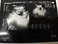 Kehamilan kembar 14w sering nyeri perut kanan bawah-20181213_175439.jpg