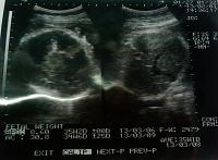 Usia kehamilan 36 Minggu, hasil test lab Hb rendah-usg-35-minggu-2-hari.jpg