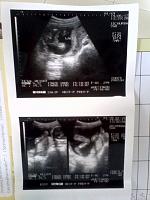 Ask : Penampakan JK baby girl di USG 2D-img_20120101_140757.jpg