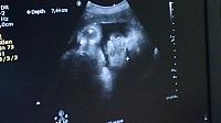 Pentingnya USG saat Kehamilan triSemester awal dan Trismester Akhir-screenshot_2014-10-18-11-12-45.jpg