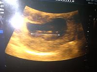 Pentingnya USG saat Kehamilan triSemester awal dan Trismester Akhir-adek-pangkalan-lesung-20140506-01904.jpg