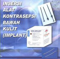 Definisi, Jenis, dan Contoh Alat Kontrasepsi serta Keuntungan  Kekurangan-implant-susuk-alak-kontrasepsi-bawah-kulit.jpg