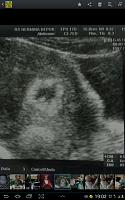 usg usia 5 minggu kantong janin pipih dan samar-screenshot_2014-05-28-19-02-13.jpg
